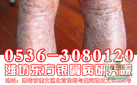 合理健康饮食对牛皮癣患者有什么重要性?【权