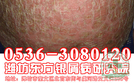 哪些中药可以有效治疗银屑病?