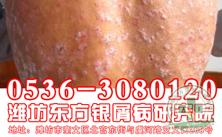 哪类人群更易患牛皮癣