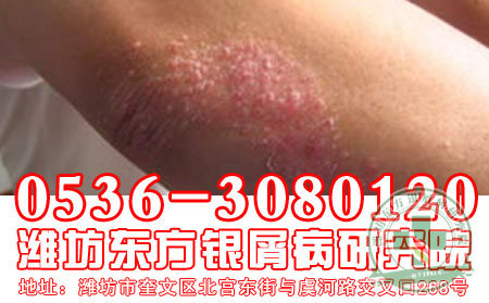 经常出汗对牛皮癣有什么影响