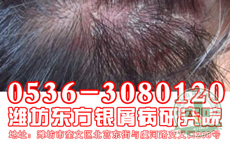银屑病会造成患者的代谢障碍出现吗?【医生推