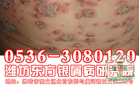 腿部银屑病大面积出现怎么办？