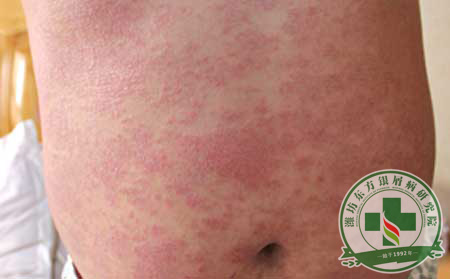 牛皮癣治疗