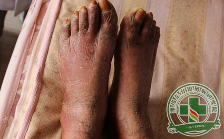 其他方治疗牛皮癣有效果吗?