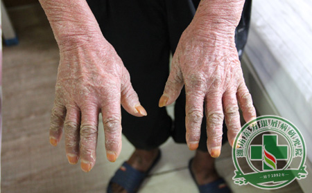 如何降低银屑病的复发几率?