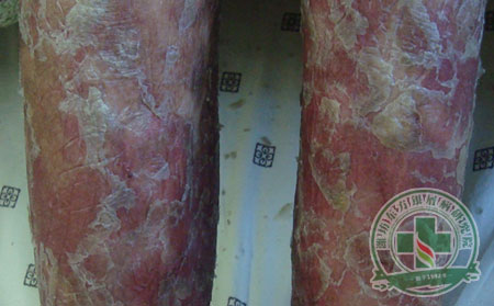 银屑病患者需要补充维生素吗?