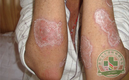 银屑病只是皮肤病吗?