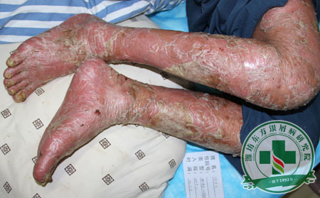 坚持中医治疗银屑病是正确的吗？