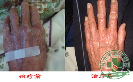银屑病患者饮酒后有哪些症状