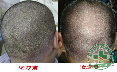 头部银屑病的治疗方法