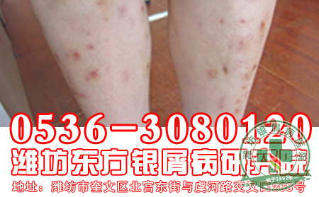 怎么治疗寻常型银屑病
