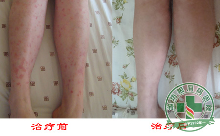 银屑病的病因是什么