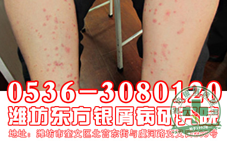 银屑病的类型症状是什么