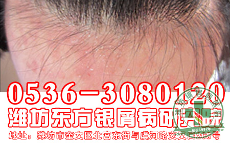 银屑病同形反应的病因
