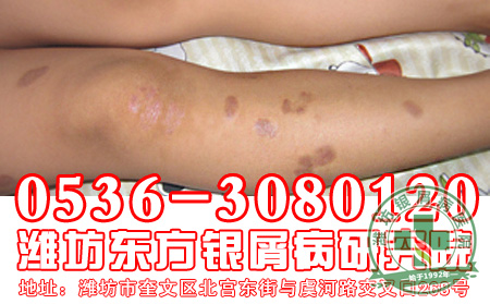 寻常型银屑病的病因