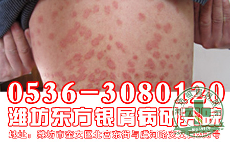 急性银屑病的病因是什么