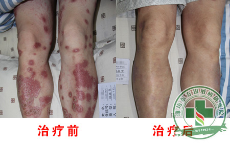 银屑病为什么总是治不可以呢?