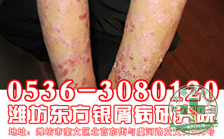 面部脓疱型银屑病的护理