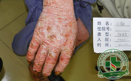 关节型银屑病容易表现出的症状是什么？