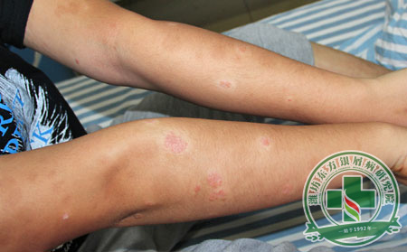 关节型银屑病治疗要知道什么?