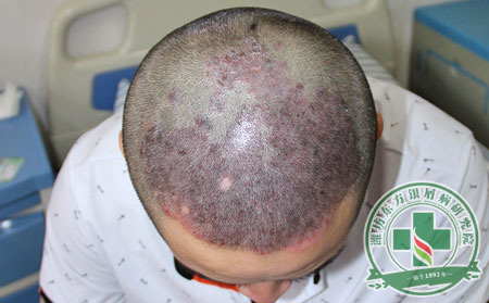 患者出现面部银屑病应该怎么做?