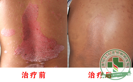 脓疱型银屑病发病症状有什么?
