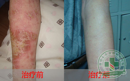 治疗关节型银屑病的方法