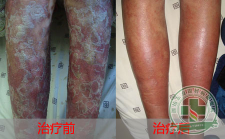 患有红皮型银屑病该怎么办