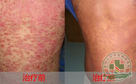 治疗银屑病的常识是什么