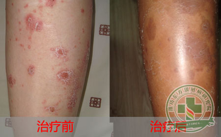 银屑病患者睡觉的常识