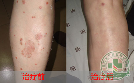 预防银屑病病情恶化