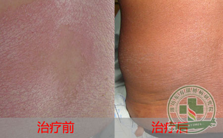 牛皮癣的治疗过程中做可以护理有什么