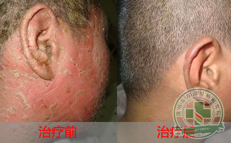 牛皮癣饮食适宜吃些什么?