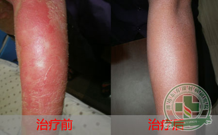 牛皮癣患者补充维生素要注意什么？