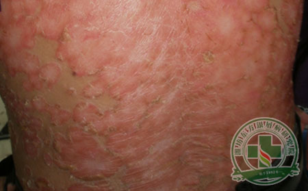 银屑病患者当心雨天受潮