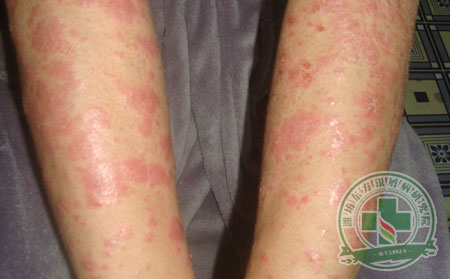 银屑病饮食对于银屑病的治疗有什么作用?