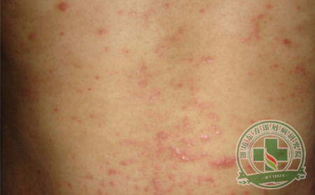 银屑病患者对于银屑病激素药物要注意什么？