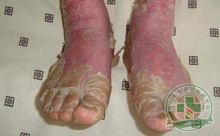 治疗银屑病哪些药物不能用?