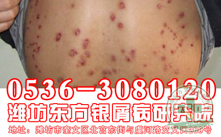 银屑病危害很大吗？