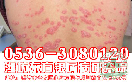 银屑病一定遗传给子女吗？