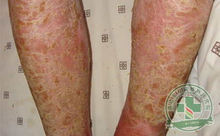 治疗脓疱型银屑病