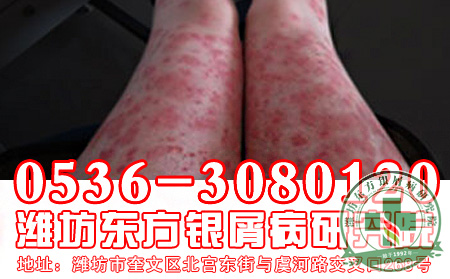 牛皮癣会给女性患者带来哪些危害？