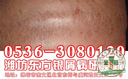 牛皮癣治疗需要注意哪些方面?
