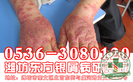 老人牛皮癣应该如何治疗?