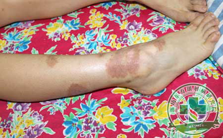 银屑病发病