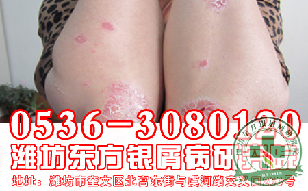 牛皮癣症状表现在哪些方面？