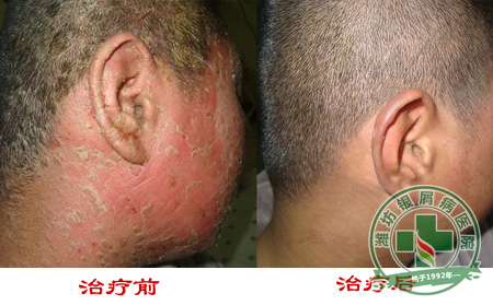 脸上银屑病有什么特点？