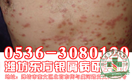 什么是银屑病的发病原因?