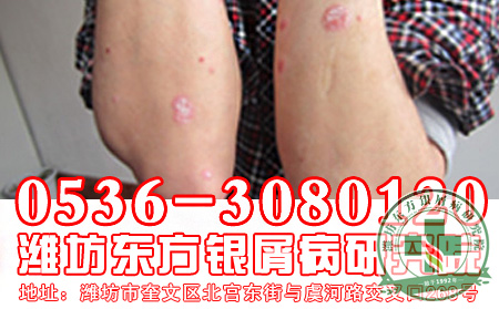 银屑病的发病原因有哪些?