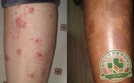 如何护理脸部牛皮癣？